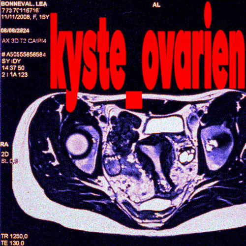 kyste_ovarien (Explicit)