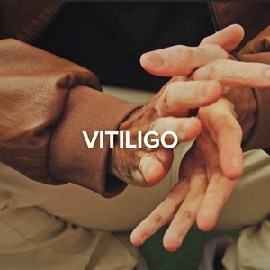 Vitiligo