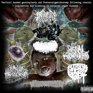 Vertical Banded Gastroplasty & Ureterosigmoidostomy Following Cranial Liquidation & Bleeding in Advanced Organ Disease (SPLIT) [Explicit]