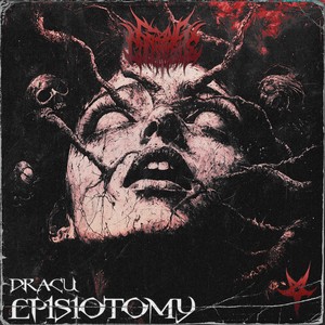 Episiotomy