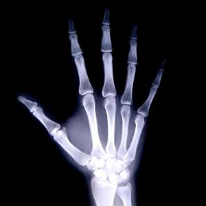 Fractured (Explicit)