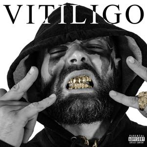 Vitiligo (Explicit)