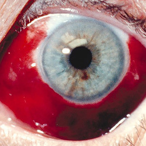 HEMORRHAGE (Remix|Explicit)