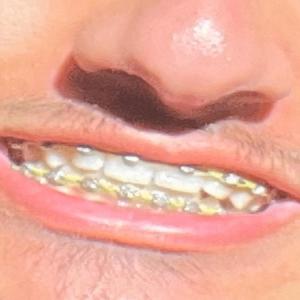 rune (Explicit)
