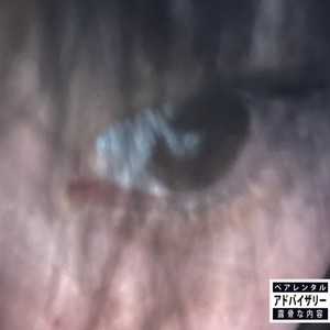 ALAS (cyberpsychosis version)