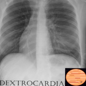 Dextrocardia