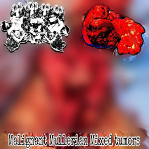 Malignant Mullerian Mixed Tumors (Explicit)