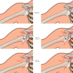 DISS-LOCATED (Explicit)