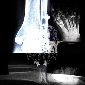 #brokenLegs (feat. chemsblood) (Explicit)