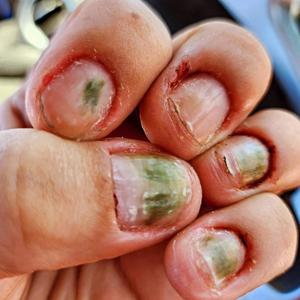 DERMATOPHAGIA (Explicit)