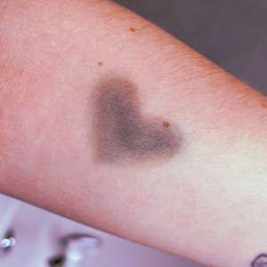 Heart Shaped Bruises