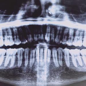 BAK2DACLERB (Explicit)