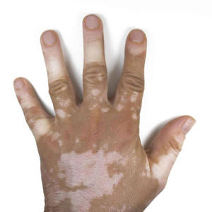 vitiligo (Explicit)