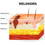 Melanoma (Explicit)