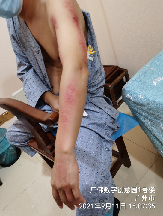 李氏砭法刮痧之全身刮