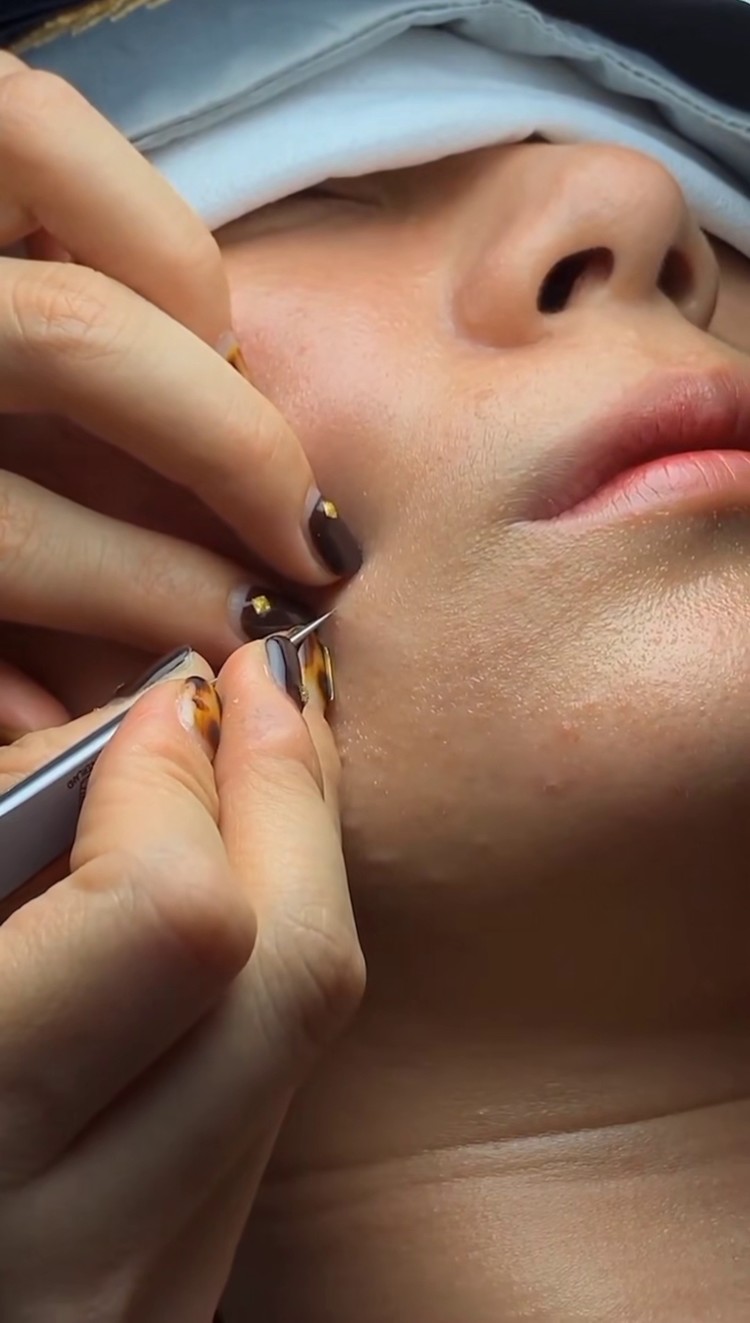 细胞夹去黑头 #细胞夹治愈瞬间 #解压视频